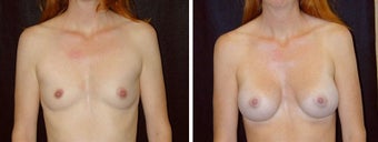 29 year old female, breast augmentation, San Francisco, California