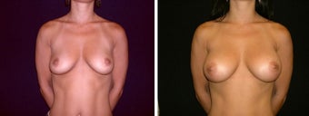 39 year old female, breast augmentation, San Francisco, California