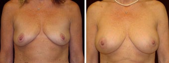 45 year old female, breast augmentation, San Francisco, California