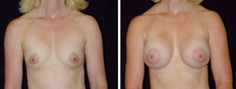 21 year old female, breast augmentation, San Francisco, California