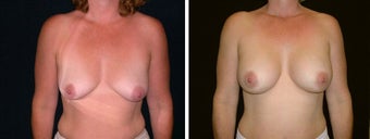 35 year old female, breast augmentation, San Francisco, California