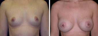 26 year old female, breast augmentation San Francisco, California