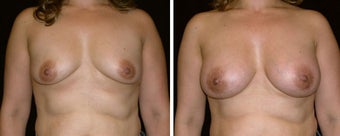 39 year old female, breast augmentation