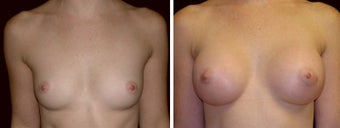 24 year old female, breast augmentation, San Francisco, California