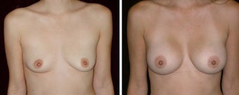 27 year old female, breast augmentation, San Francisco, California