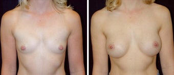 29 year old female, breast augmentation, San Francisco, California