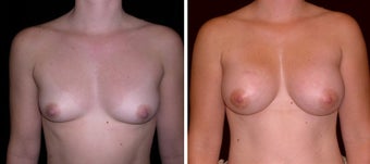 29 year old female, breast augmentation, San Francisco, California