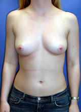 Breast Augmentation