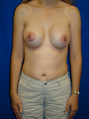 Revisionary Breast Surgery