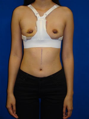 Breast Reconstruction Symmastia Repair