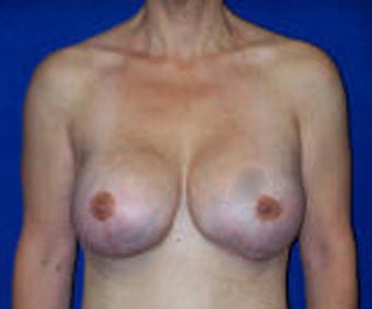 Reconstruction Surgery