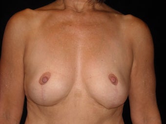 58 year old lady wanted implant removal and a breast lift