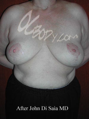Breast Implant Removal with Full Breast Lift