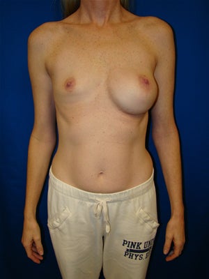 Revisionary Breast Surgery