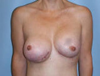 Reconstruction Surgery