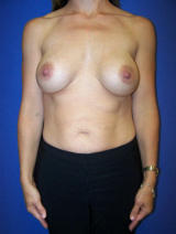 Breast Implant Revision