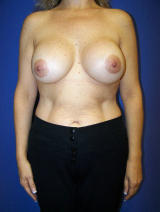 Implant Exchange (Saline to Silicone-Gel)