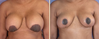 Breast Implant Removal