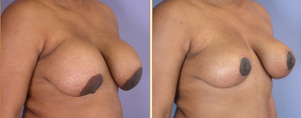 Breast Implant Removal