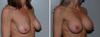 Breast implant revision