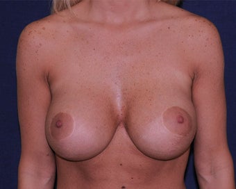 breast implant revision