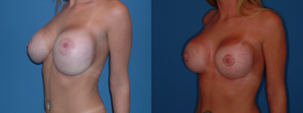 Implant exchange/capsulorrhaphy/circumarealar mastopexy