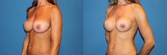 Implant exchange/capsulorrhaphy/symmastia repair