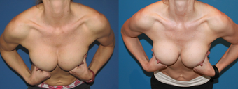 symmastia repair with acellular dermal matrix