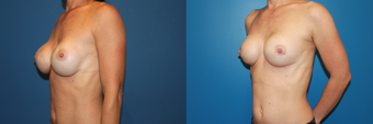 capsulectomy/repostion of implants submuscular