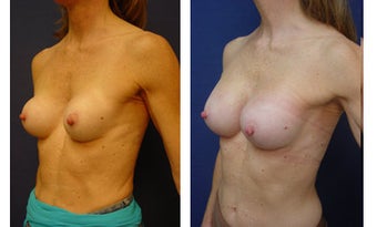 Breast implant correction