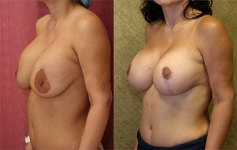 breast implant revision