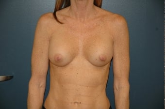 Breast implant revision