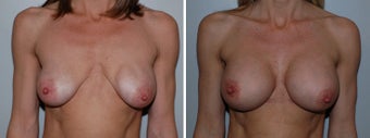 Breast implant revision