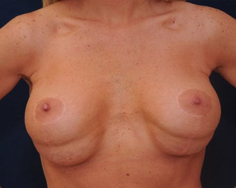 breast implant revision