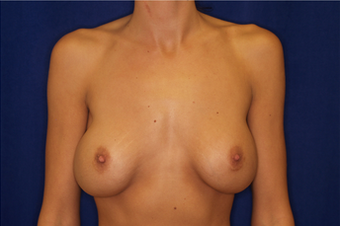 Breast Implant Revision