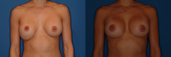 Breast Revision/Capsulorrhaphy