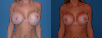Implant exchange/capsulorrhaphy/circumarealar mastopexy