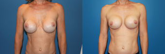 capsulectomy/repostion of implants submuscular