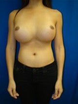 Revision Breast Surgery