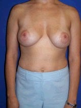 Revision Breast Surgery