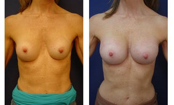 Breast implant correction