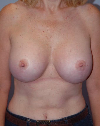 Breast Augmentation Style 410