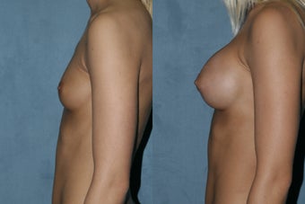 Breast Augmentation - Silicone Implants