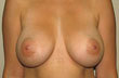 Breast Augmentation