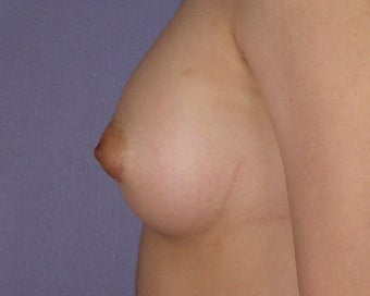 Breast Augmentation