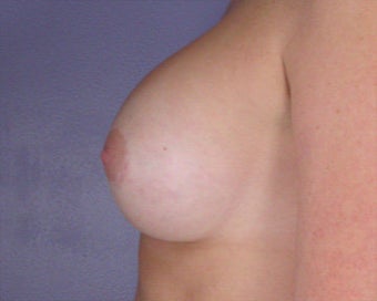 Breast Augmentation