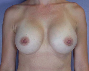 Breast Augmentation