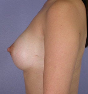Breast Augmentation