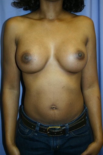 Breast Augmentation 