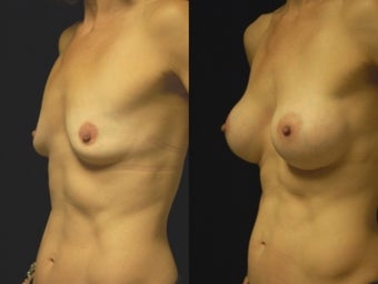 Breast augmentation, gel implants